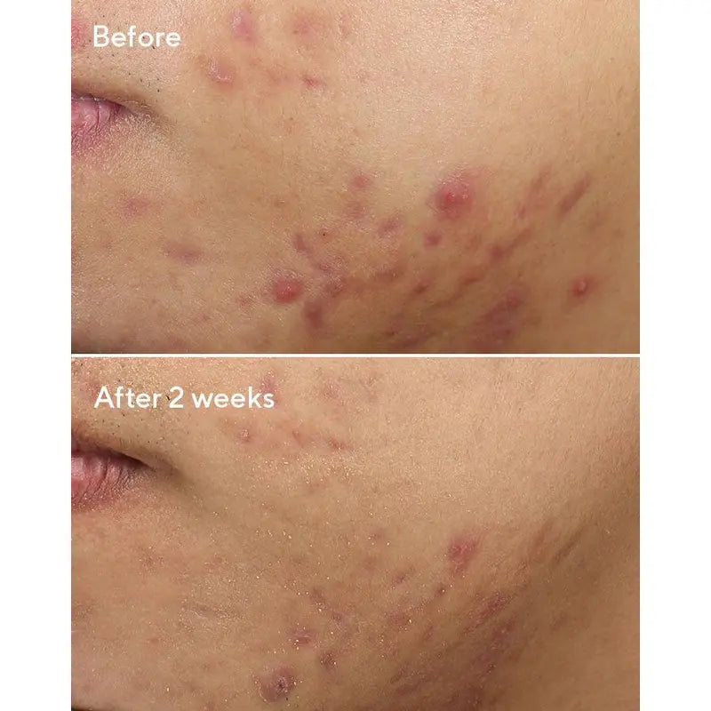 Professional title: "Advanced Deep Relief Acne Treatment"